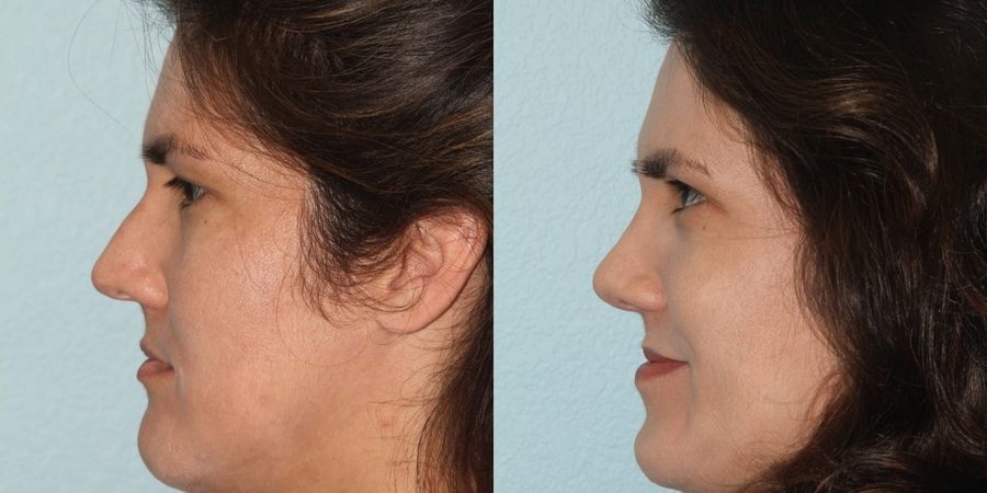 Facelift - Thumbnail 3