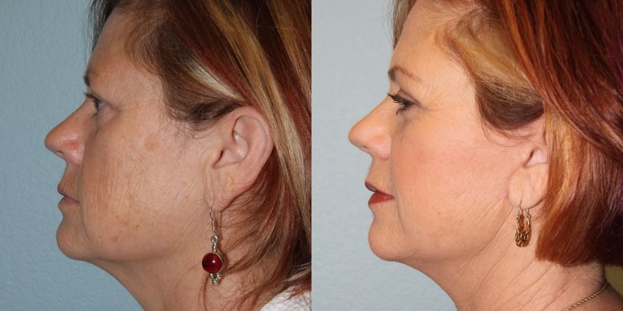 Facelift - Thumbnail 3