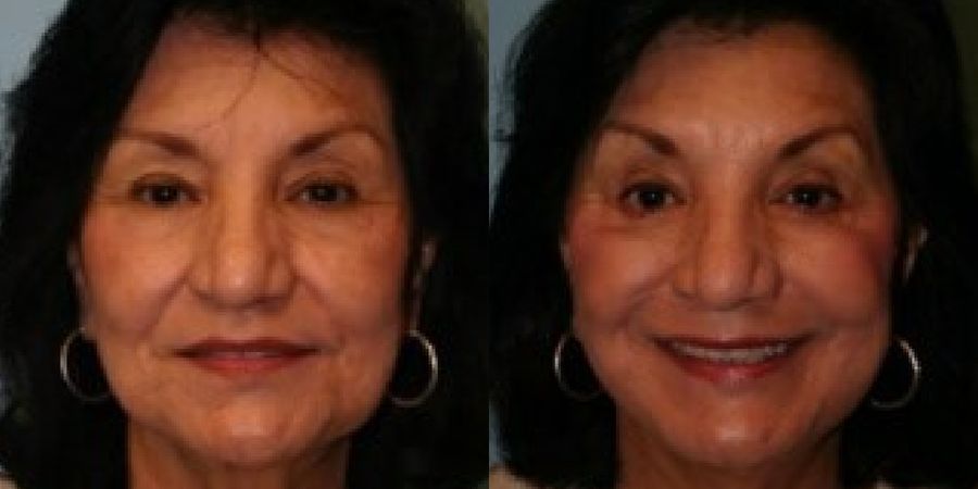 Facelift - Case 19430