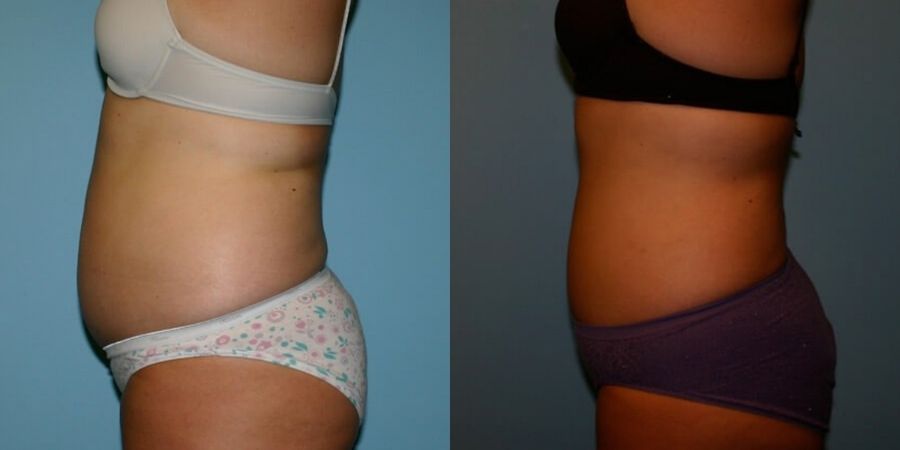 Liposuction - Thumbnail 2