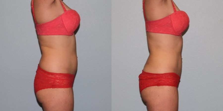 Liposuction - Thumbnail 2