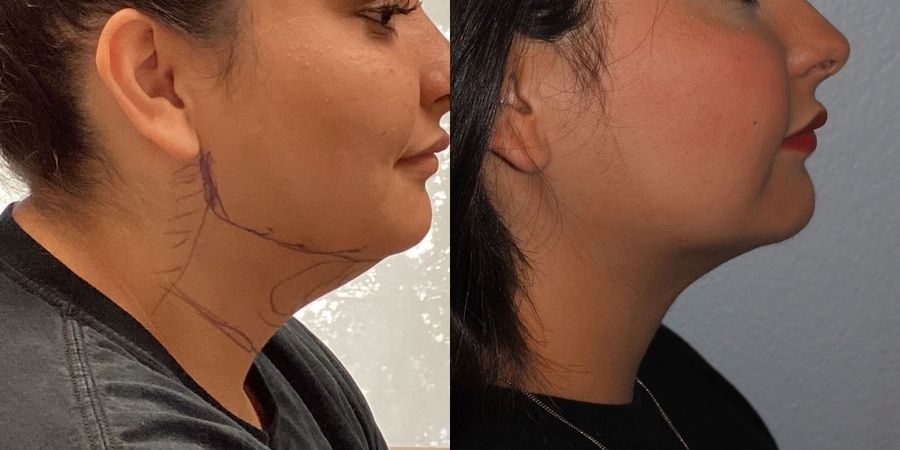 Liposuction - Thumbnail 3