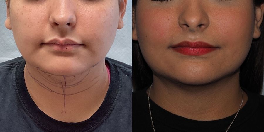 Liposuction - Case 19139