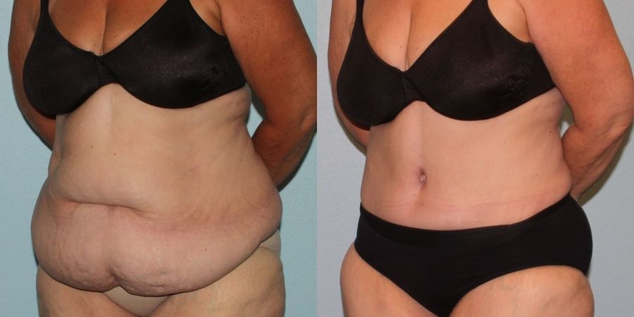 Liposuction - Thumbnail 2