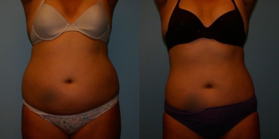 Liposuction - Case 19133