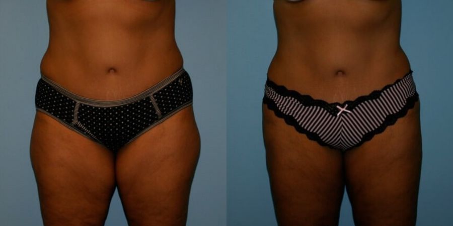 Liposuction - Case 19132