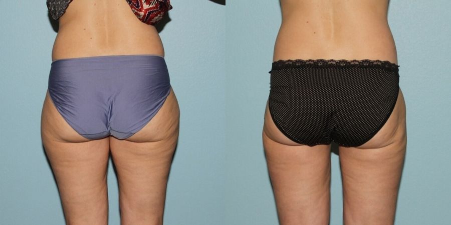 Liposuction - Thumbnail 2