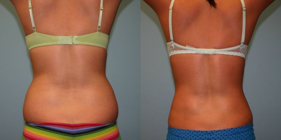 Liposuction - Thumbnail 3