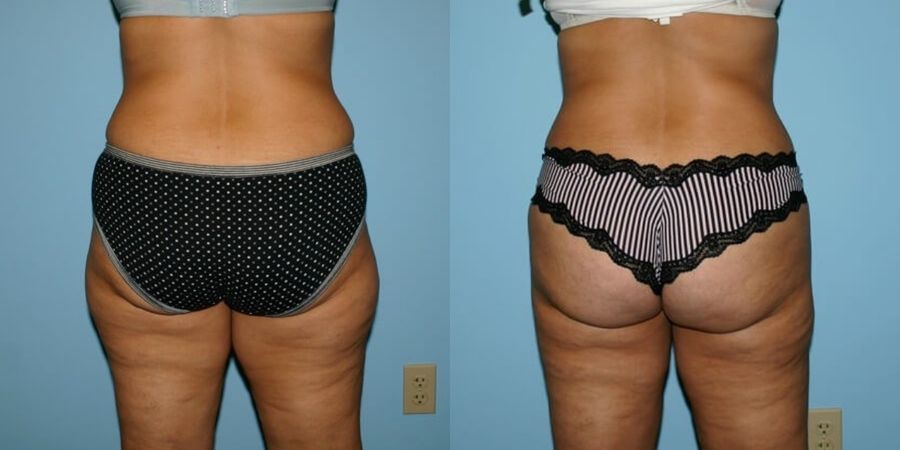 Liposuction - Thumbnail 2