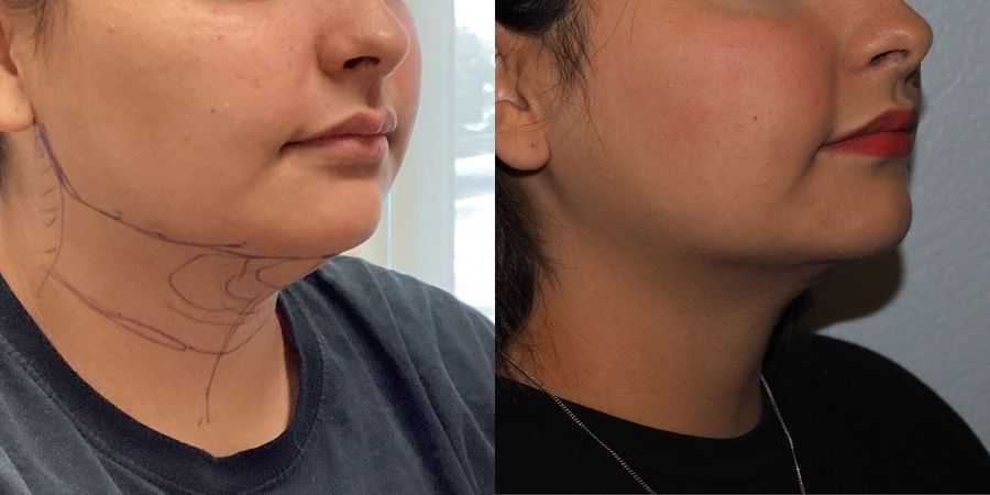 Liposuction - Thumbnail 2