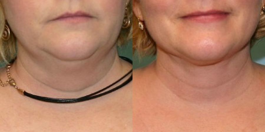 Liposuction - Case 19138