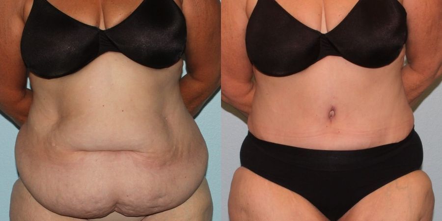 Liposuction - Case 19127