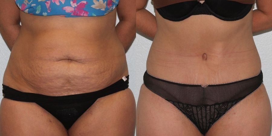 Liposuction - Case 19129