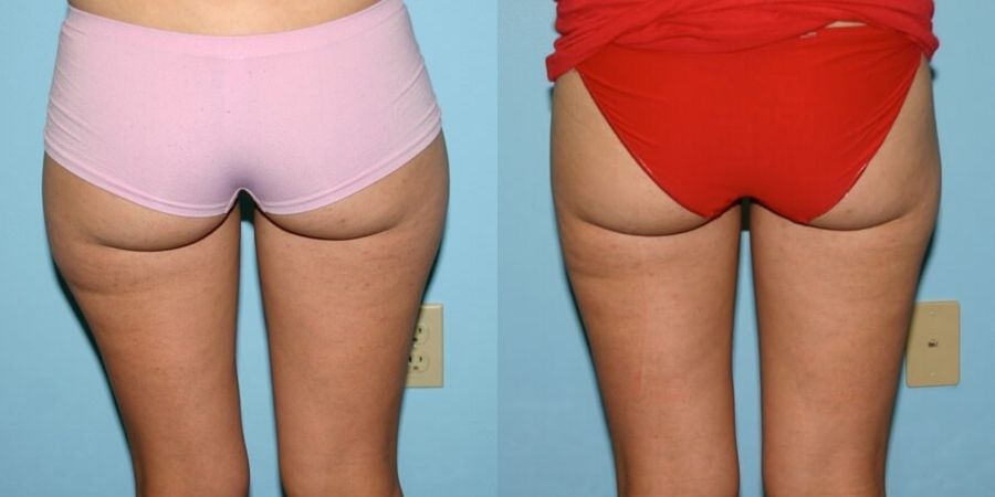 Liposuction - Thumbnail 2