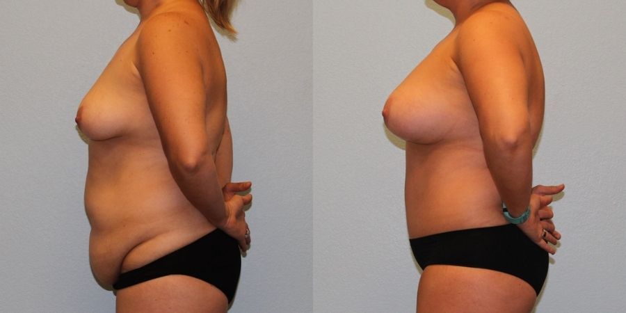 Liposuction - Thumbnail 3