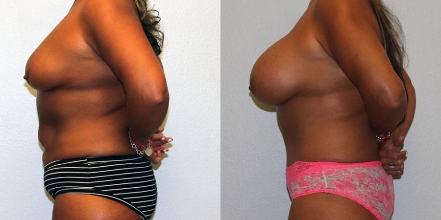 Liposuction - Thumbnail 3