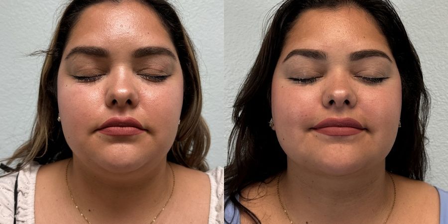 Liposuction - Case 19141