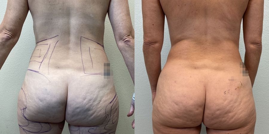 Liposuction - Thumbnail 3