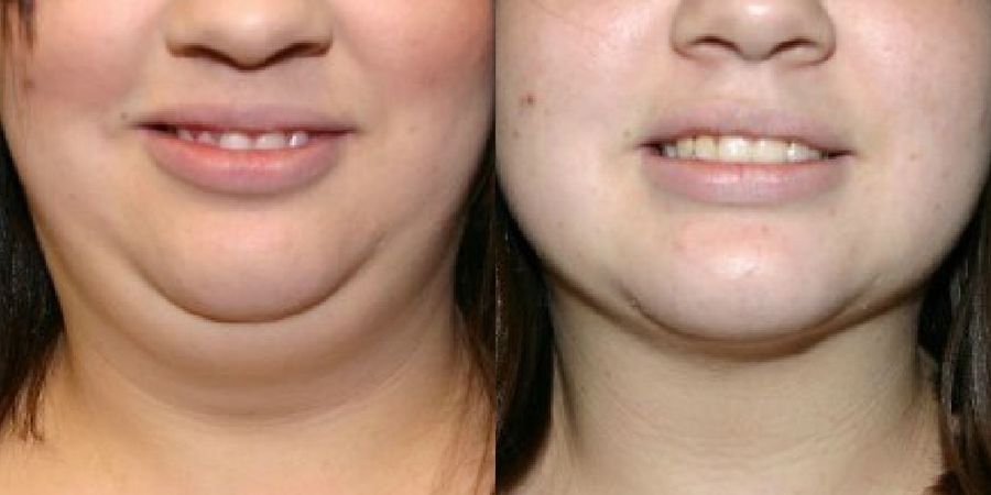 Liposuction - Case 19136