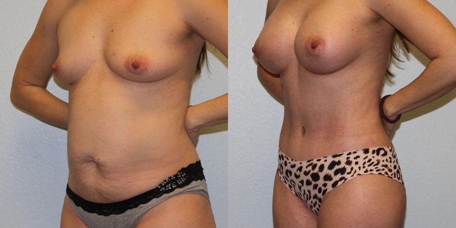 Mommy Makeover - Thumbnail 2