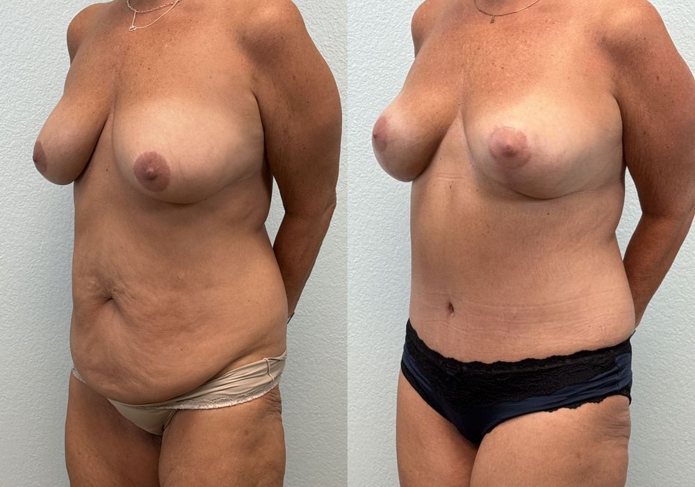 Before photo - Angle 2