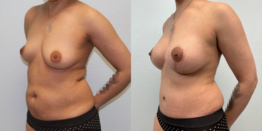 Mommy Makeover - Thumbnail 2