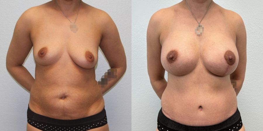 Mommy Makeover - Case 19189