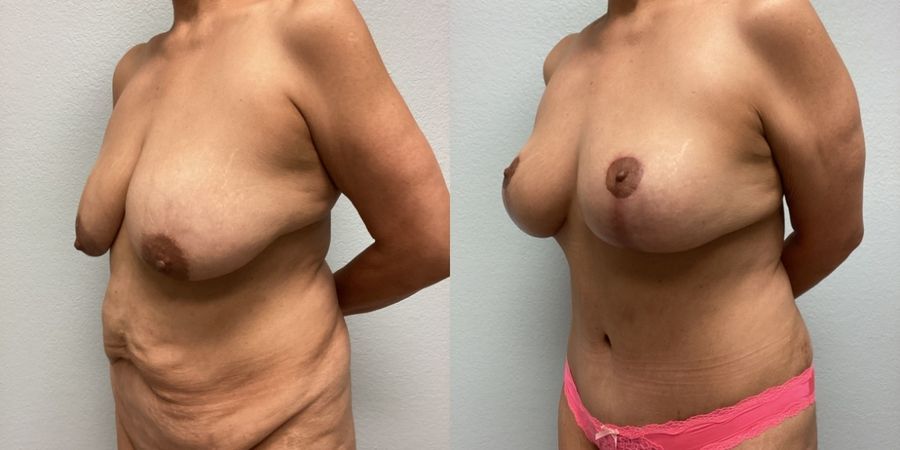 Mommy Makeover - Thumbnail 2