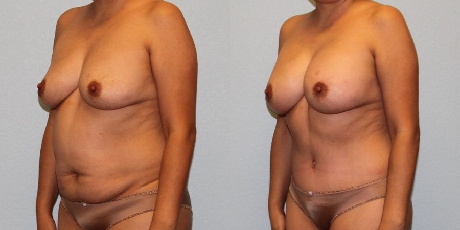 Mommy Makeover - Thumbnail 2