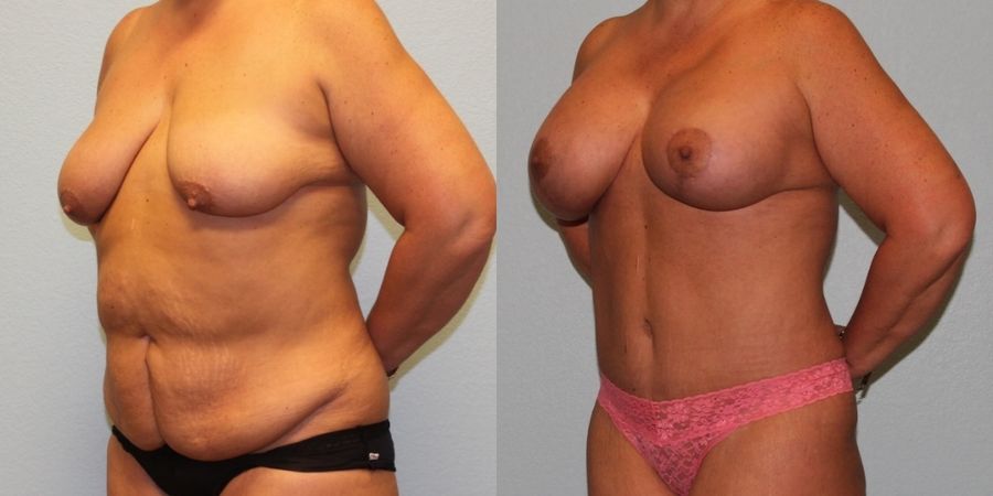 Mommy Makeover - Thumbnail 2