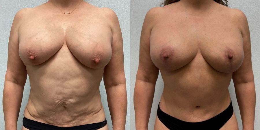 Mommy Makeover - Case 19190