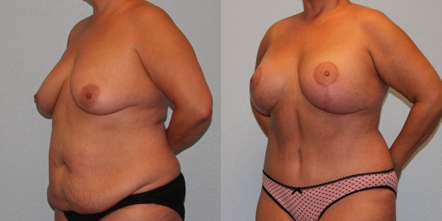 Mommy Makeover - Thumbnail 2