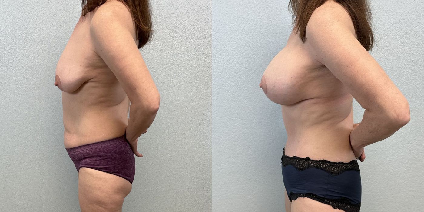 Mommy Makeover - Thumbnail 3