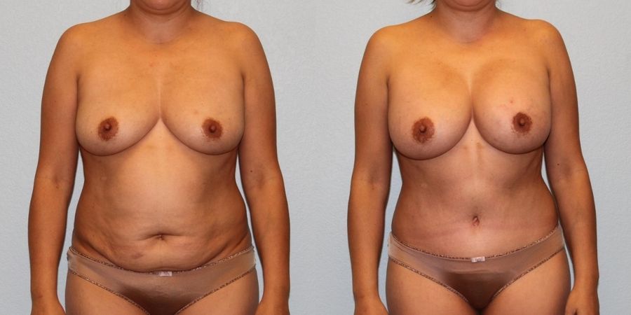 Mommy Makeover - Case 19184