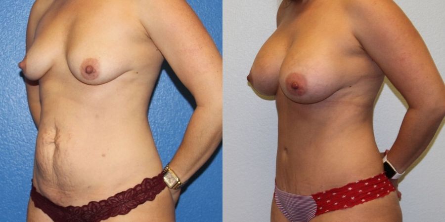 Mommy Makeover - Thumbnail 2