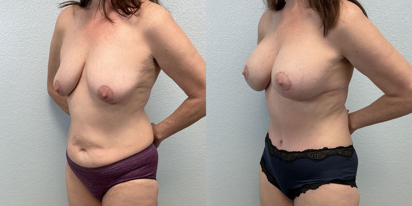 Mommy Makeover - Thumbnail 2