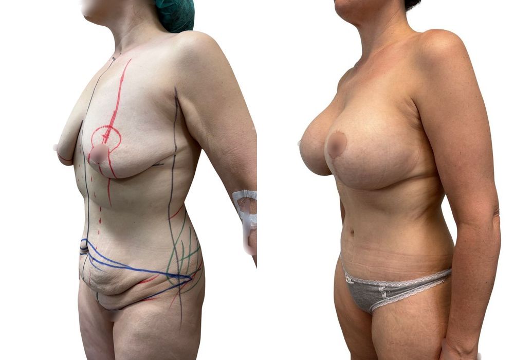 Mommy Makeover - Thumbnail 2