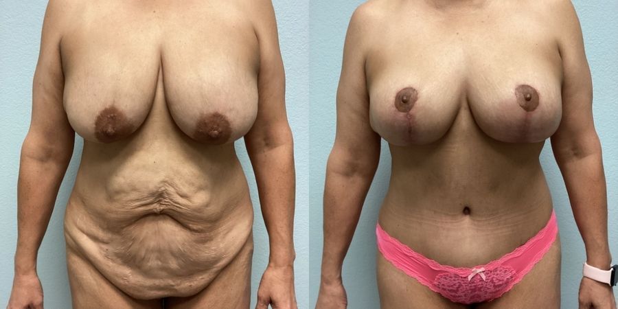 Mommy Makeover - Case 19191