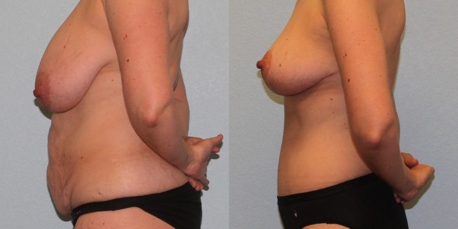 Mommy Makeover - Thumbnail 3