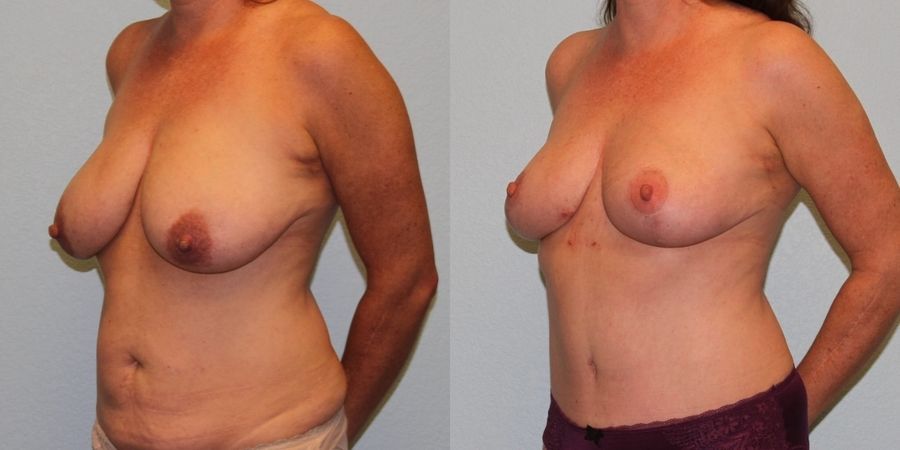 Mommy Makeover - Thumbnail 2