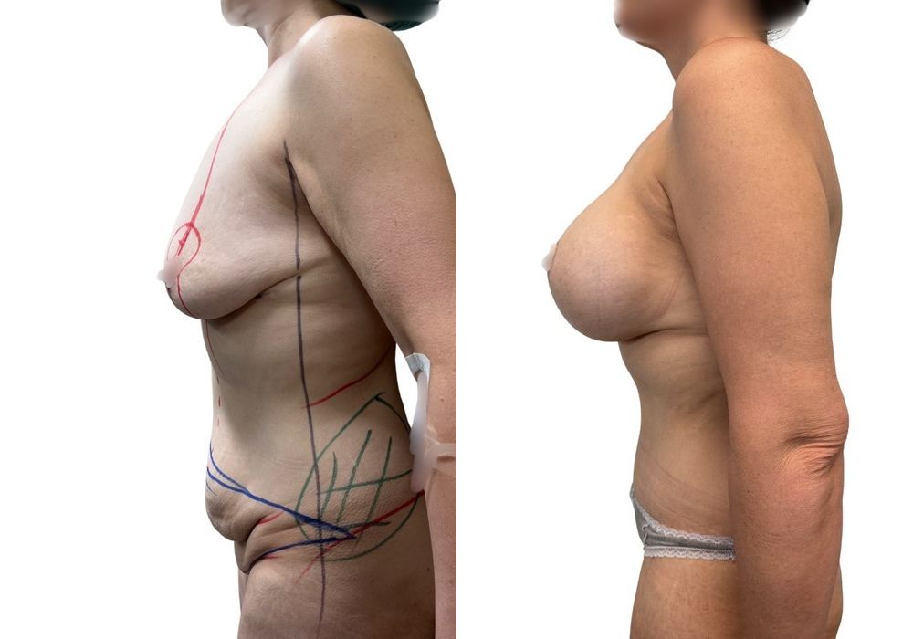 After Weight Loss - Thumbnail 3