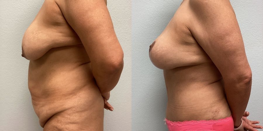 Mommy Makeover - Thumbnail 3