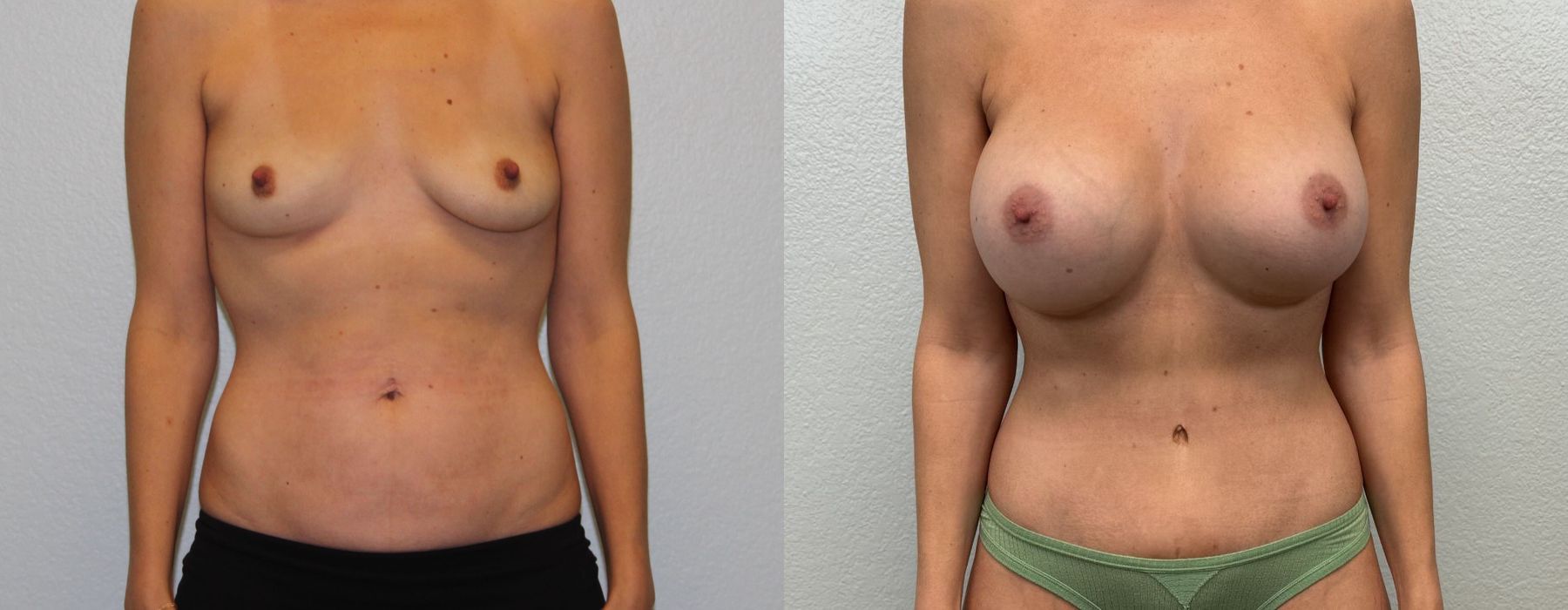 Breast Augmentation - Case 19351