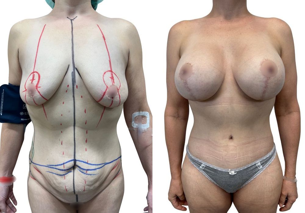 After Weight Loss - Case 19442