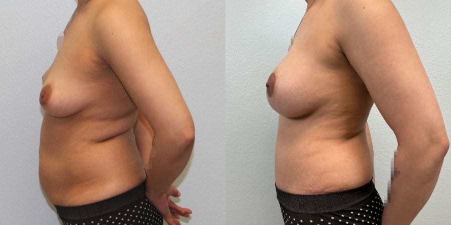 Mommy Makeover - Thumbnail 3