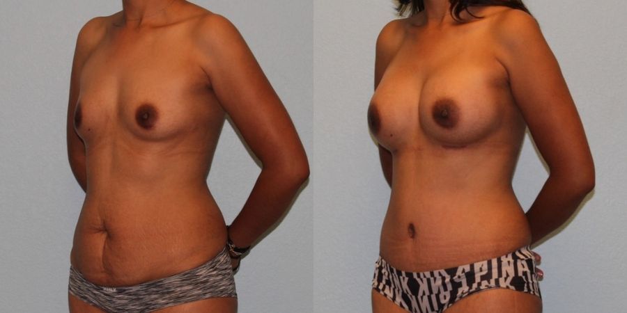 Mommy Makeover - Thumbnail 2