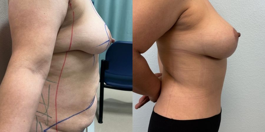 Mommy Makeover - Thumbnail 3