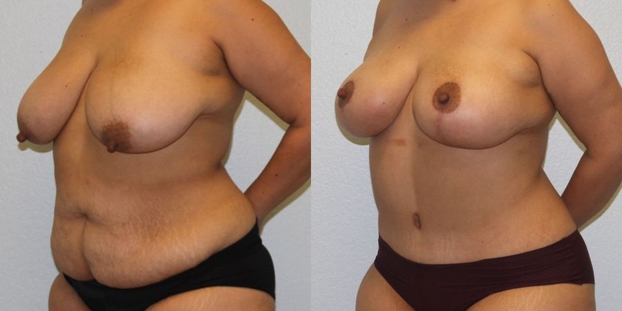 Mommy Makeover - Thumbnail 2