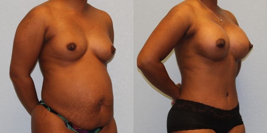 Mommy Makeover - Thumbnail 2