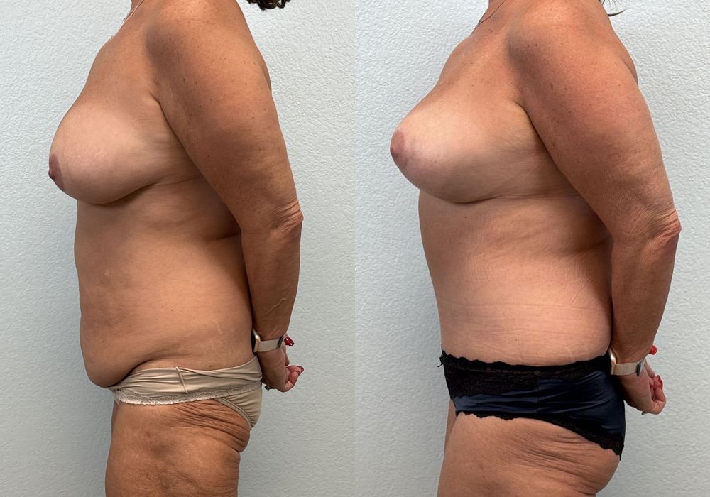 Mommy Makeover - Thumbnail 3